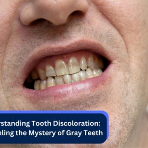 Understanding Tooth Discoloration: Unraveling the Mystery of Gray Teeth