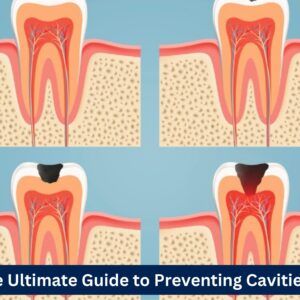The Ultimate Guide to Preventing Cavities