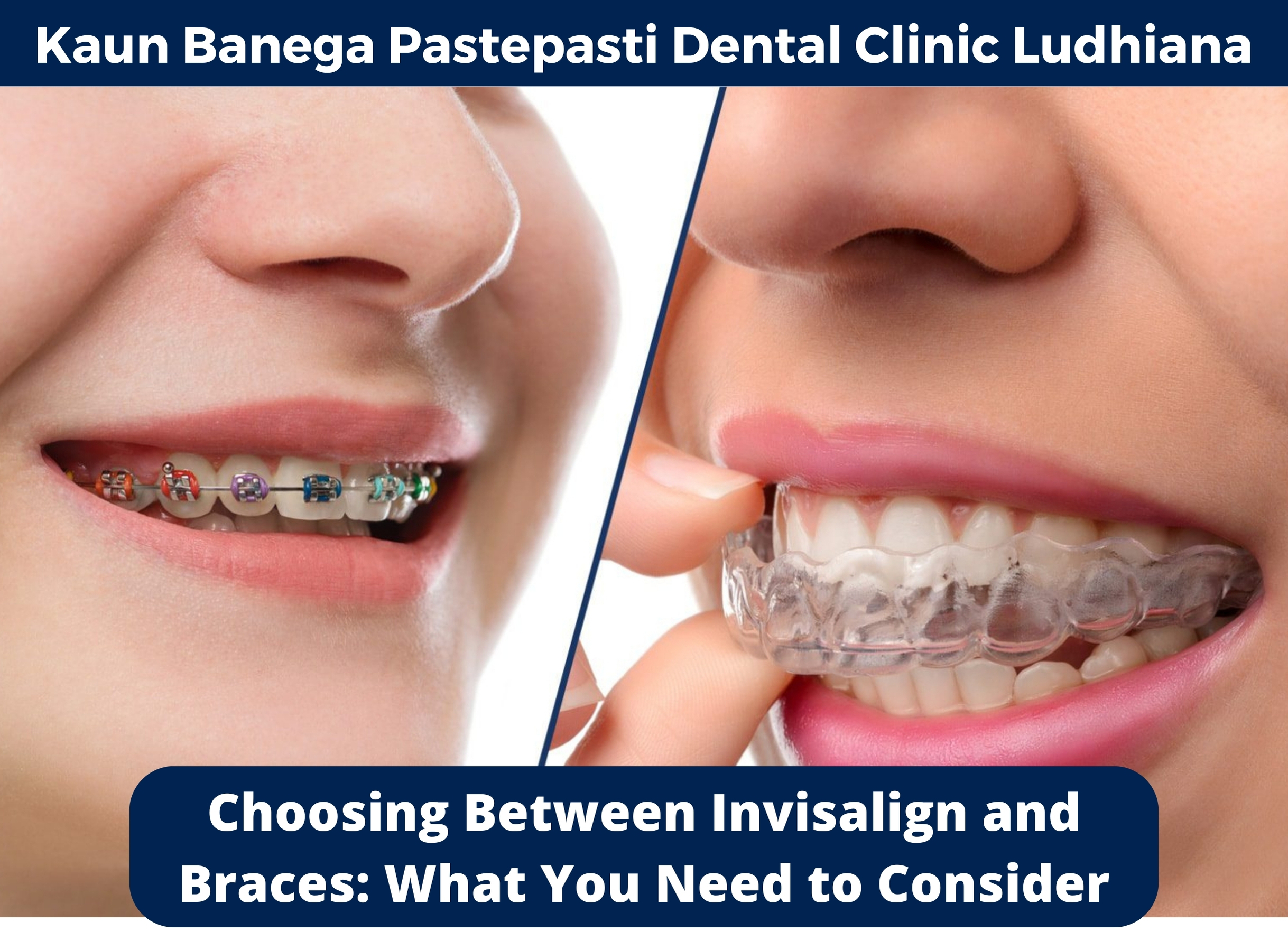 Choosing Between Invisalign and Braces: What You Need to Consider